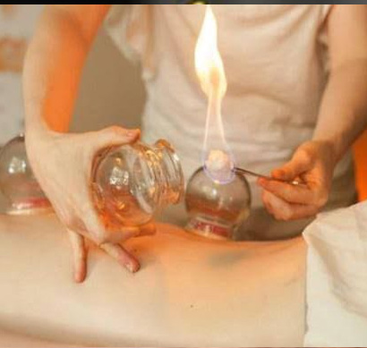 Fire Cupping