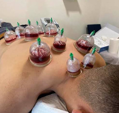 Hijama Therapy