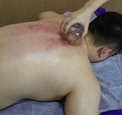Moving Cupping