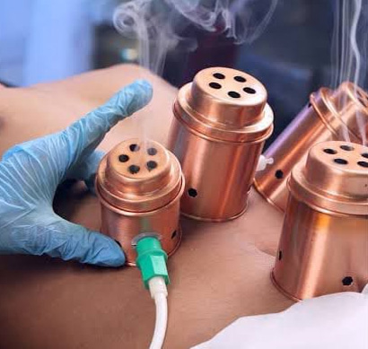 Moxa cupping
