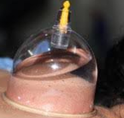 Water Cupping